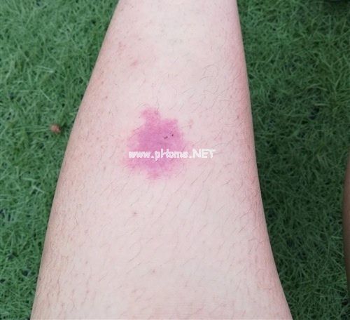 被蚊子咬的幽默句子 被蚊子咬了发个说说30句